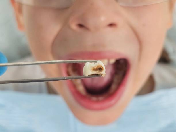 Best Emergency Treatment for Dental Infections or Abscesses in Wyandotte, MI
