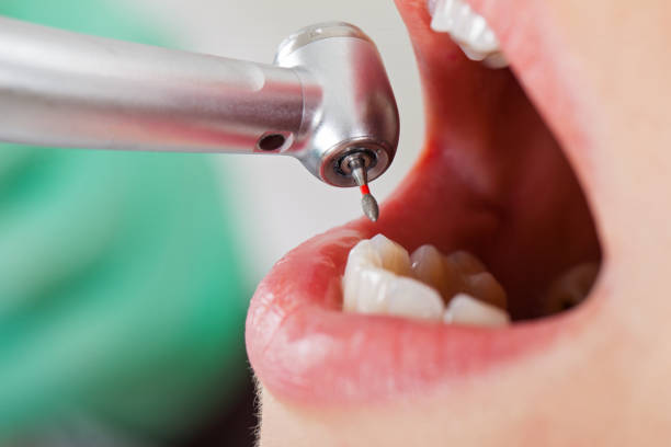 Best Emergency Dental Care for Broken or Chipped Teeth in Wyandotte, MI